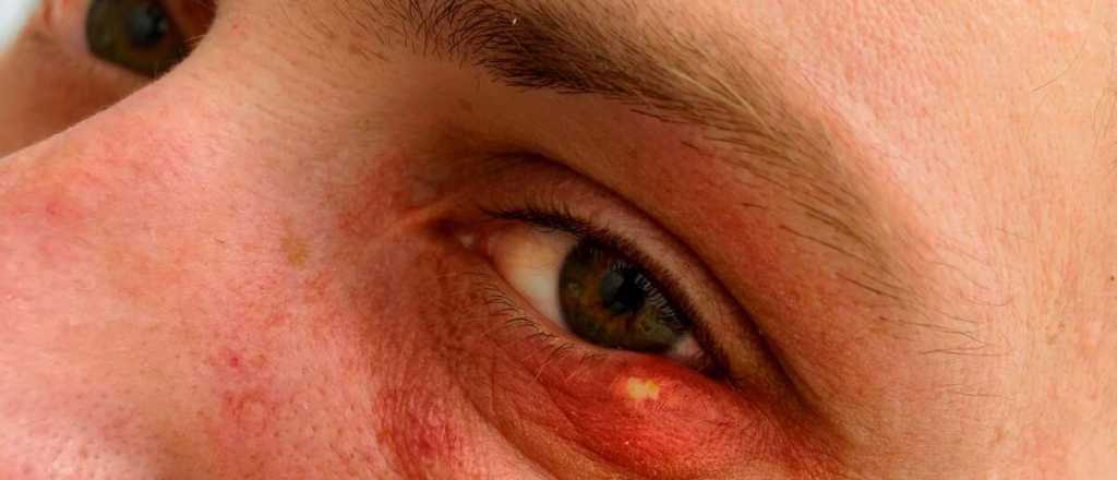 Así podés curar un orzuelo
