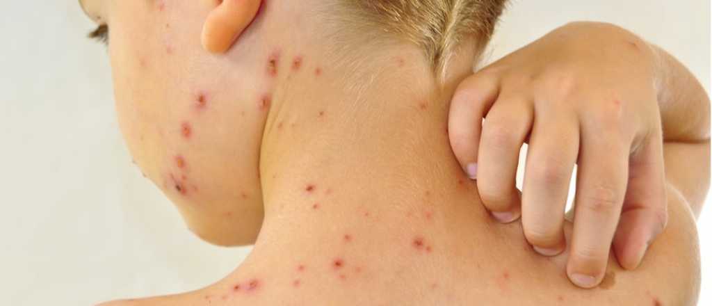 Preocupación por el aumento de una infección que afecta la piel y el aparato respiratorio