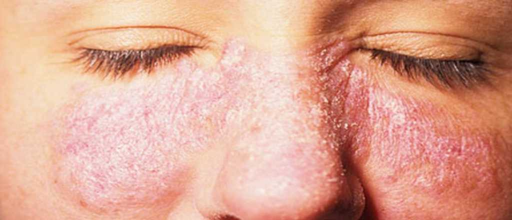 El medicamento que podr&iacute;a ser eficaz contra el lupus eritematoso sist&eacute;mico