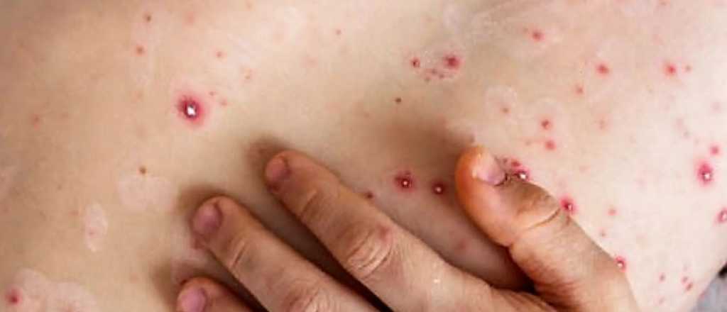 Argentina ya registr&oacute; seis casos de viruela del mono