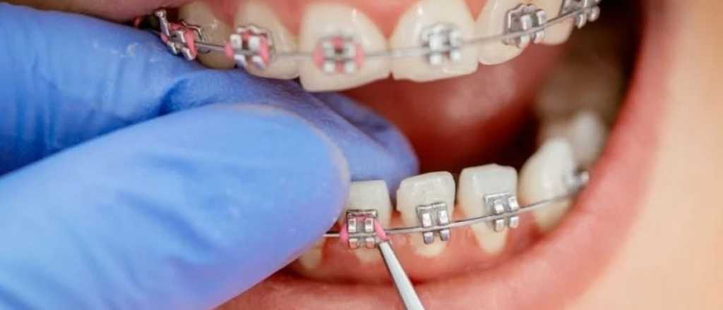 La ANMAT prohibió la venta de una marca de "brackets truchos"