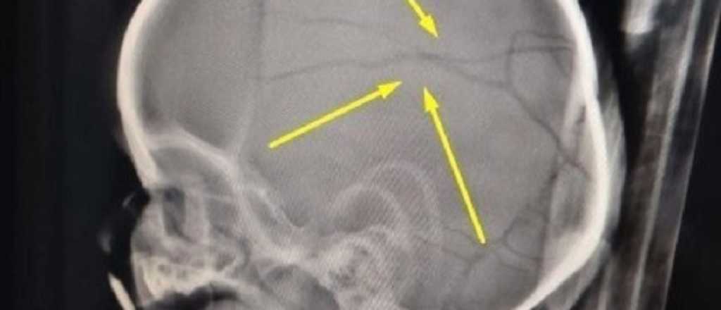 Liberaron a un golpeador de niños y ahora le partió la cabeza a un bebé