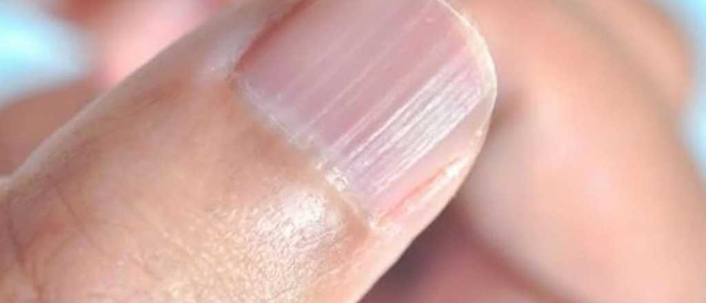 Manchas o l&iacute;neas en las u&ntilde;as: por qu&eacute; aparecen y qu&eacute; significan  