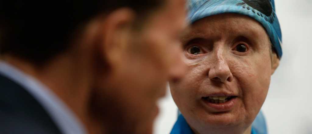 Un mono la desfiguró, la operaron y ahora su cuerpo rechaza su nueva cara