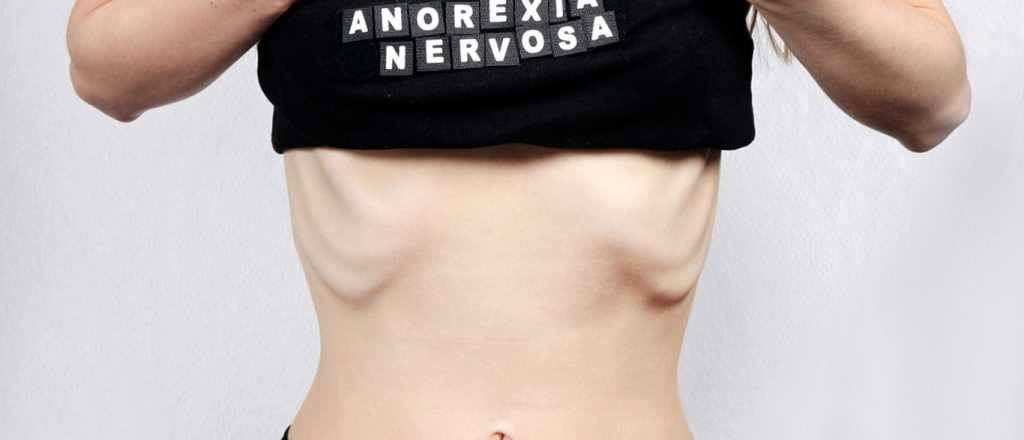 Dos hermanas competían por adelgazar y una enfermó gravemente