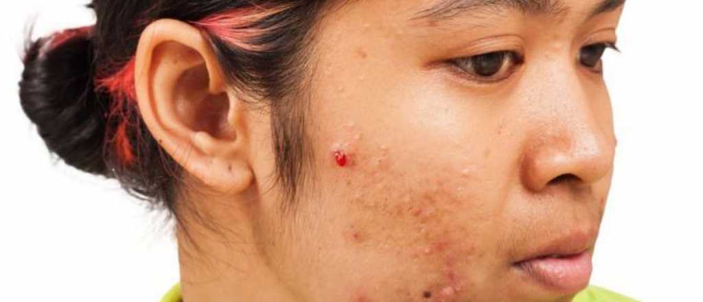 Alerta por el superacné: cómo se trata