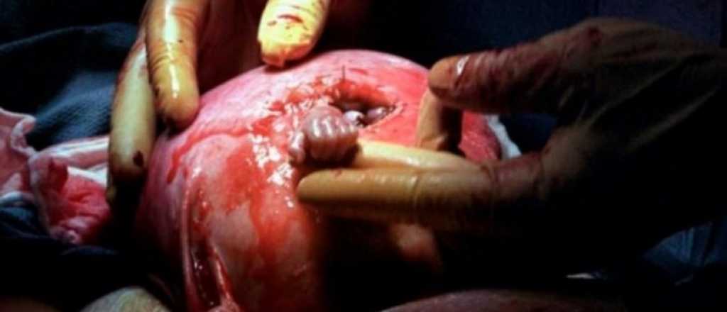 Mir&aacute; c&oacute;mo est&aacute; ahora el beb&eacute; de la primera operaci&oacute;n intrauterina