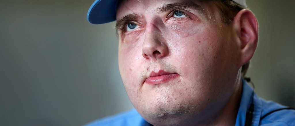 As&iacute; est&aacute; hoy el hombre que recibi&oacute; el primer transplante de rostro